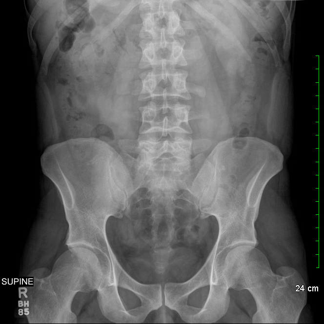 Normal Abdominal X Ray