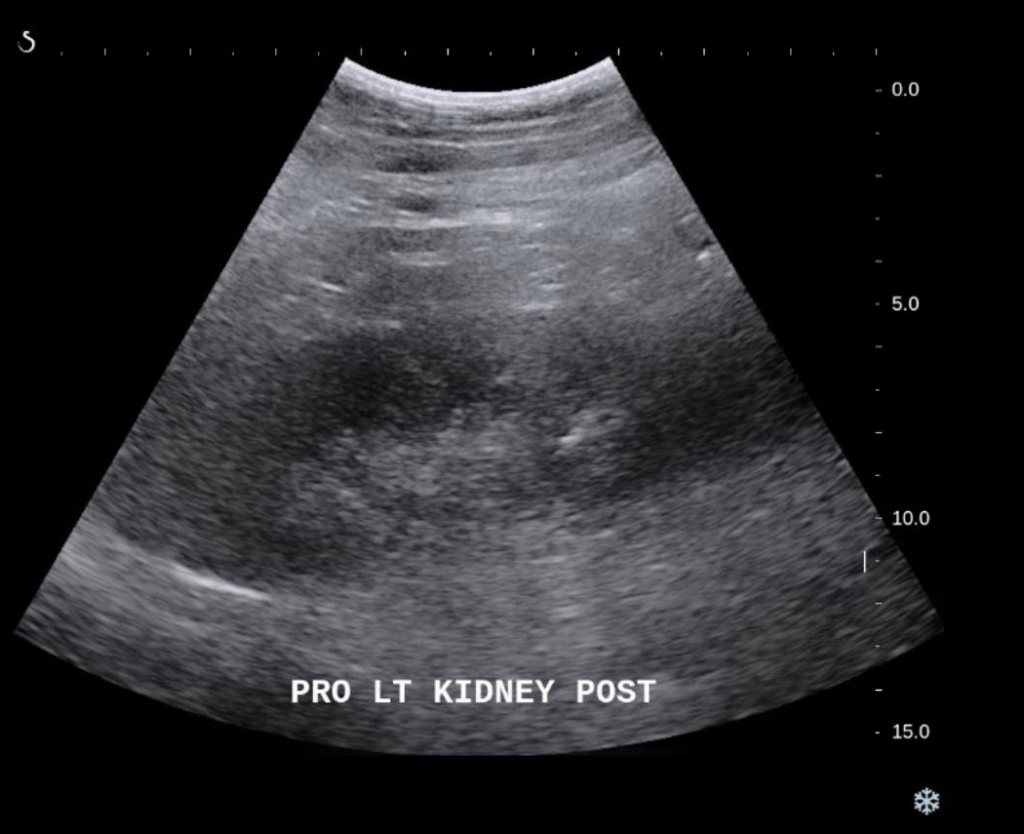 Interventional Radiology Procedures Ultrasound Guided NonFocal Renal Biopsy Stepwards