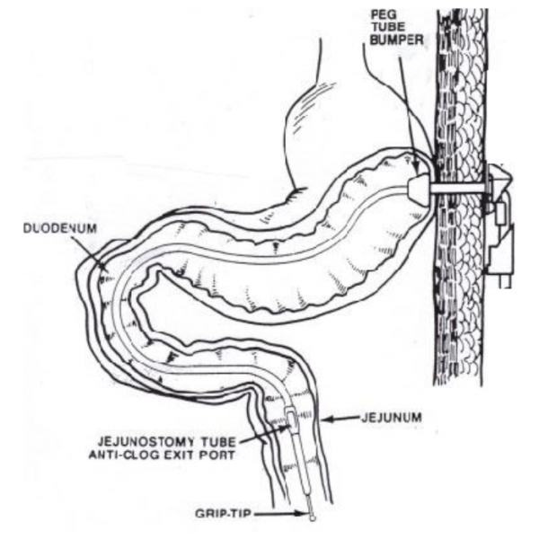 Condition Specific Radiology: Transgastric J-Tubes - Stepwards