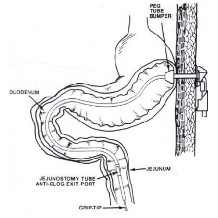 Condition Specific Radiology: Transgastric J-Tubes - Stepwards.