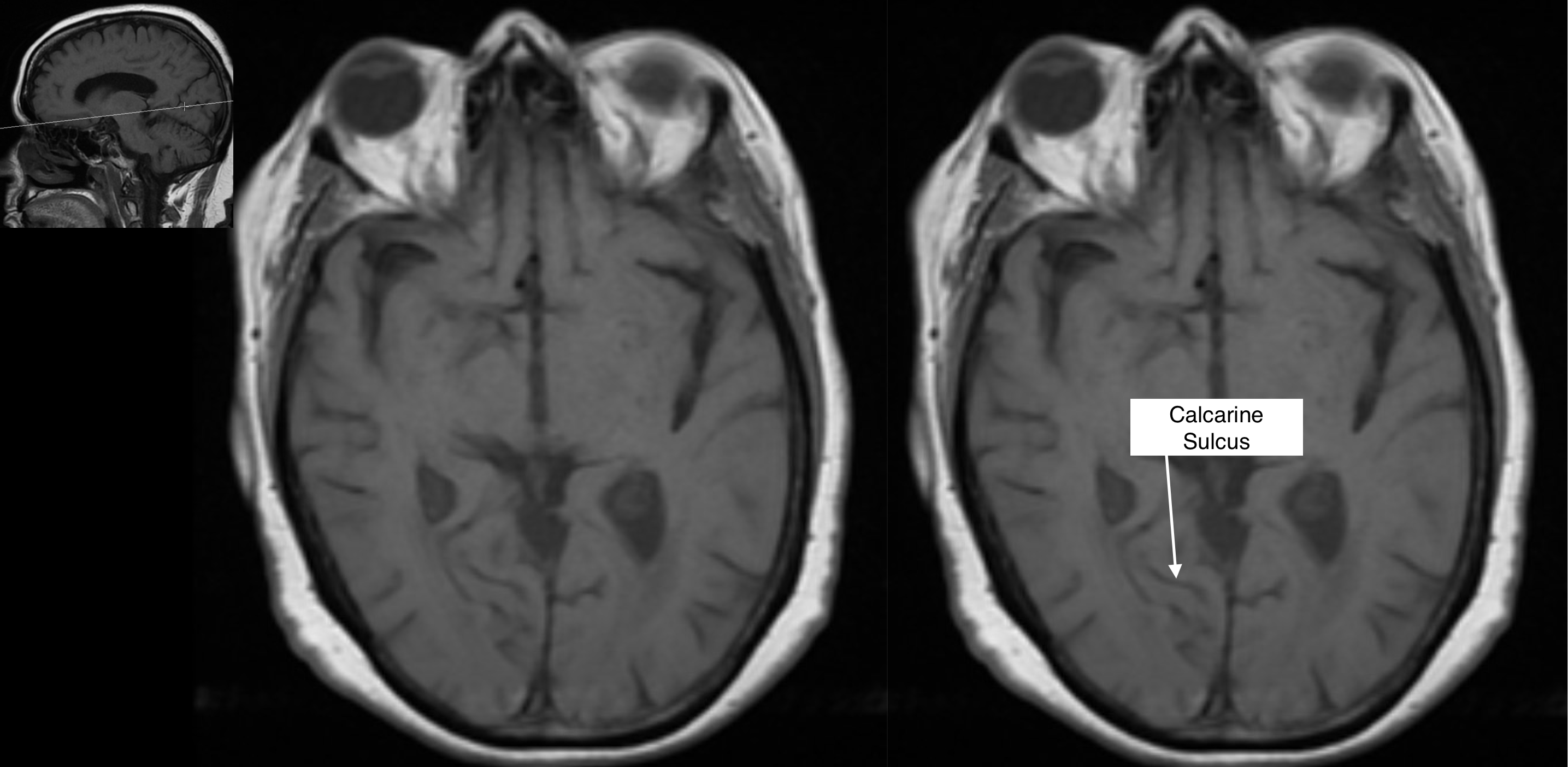 Radiological Anatomy: Calcarine Sulcus - Stepwards