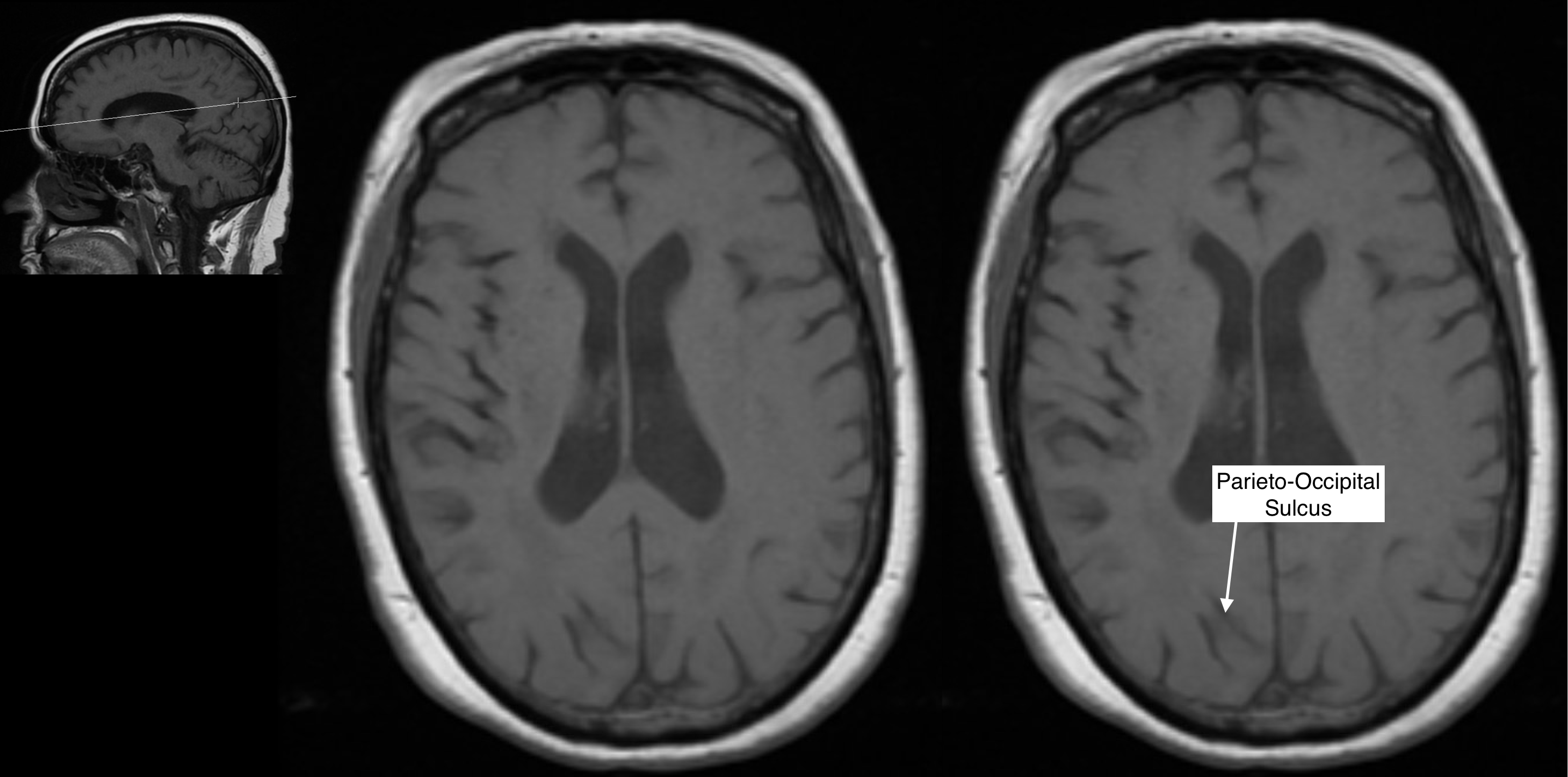 Radiological Anatomy: Parieto-Occipital Sulcus - Stepwards