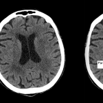 Radiological Anatomy: Parieto-Occipital Sulcus - Stepwards