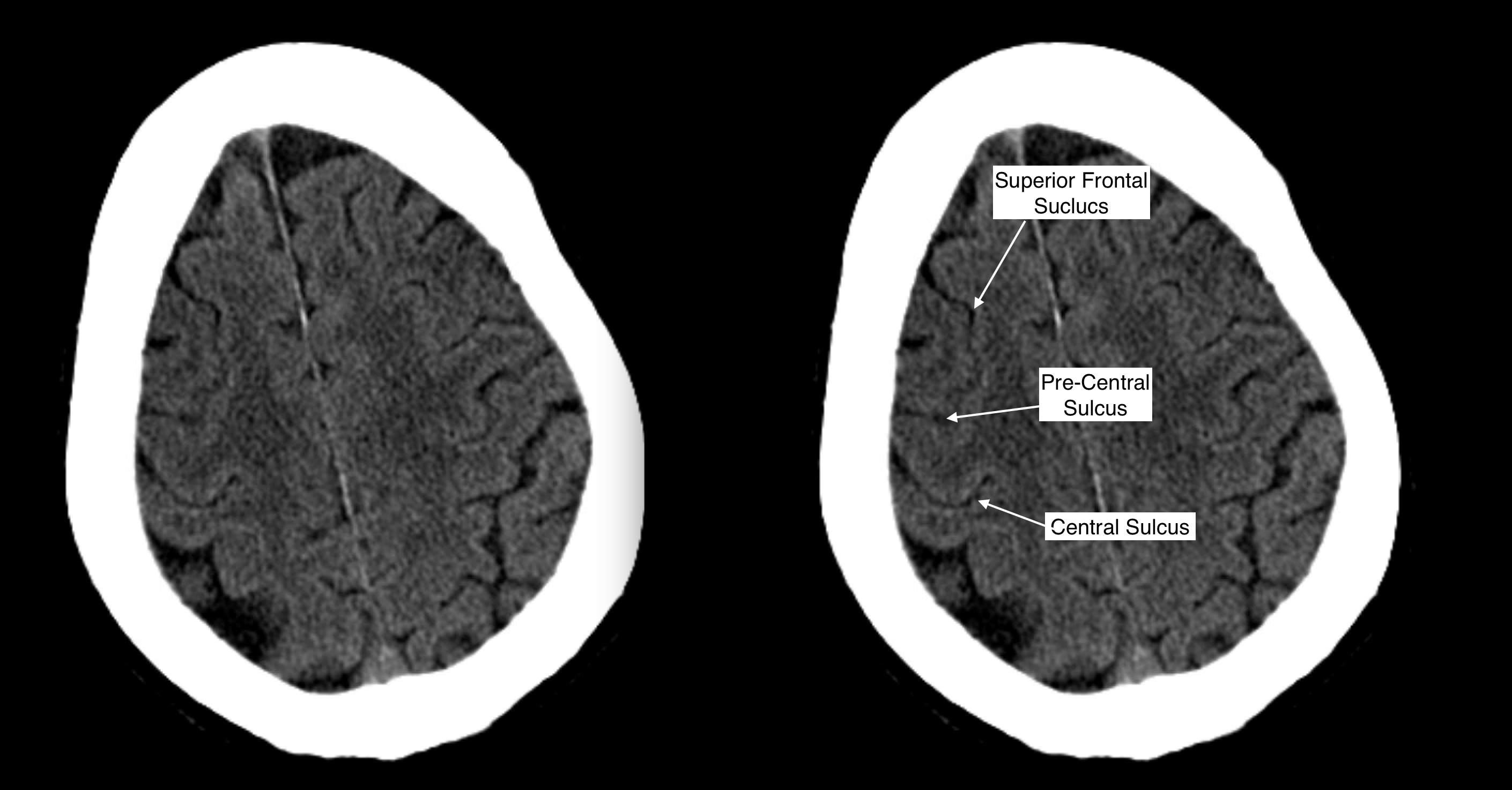 Radiological Anatomy: Central Sulcus - Stepwards
