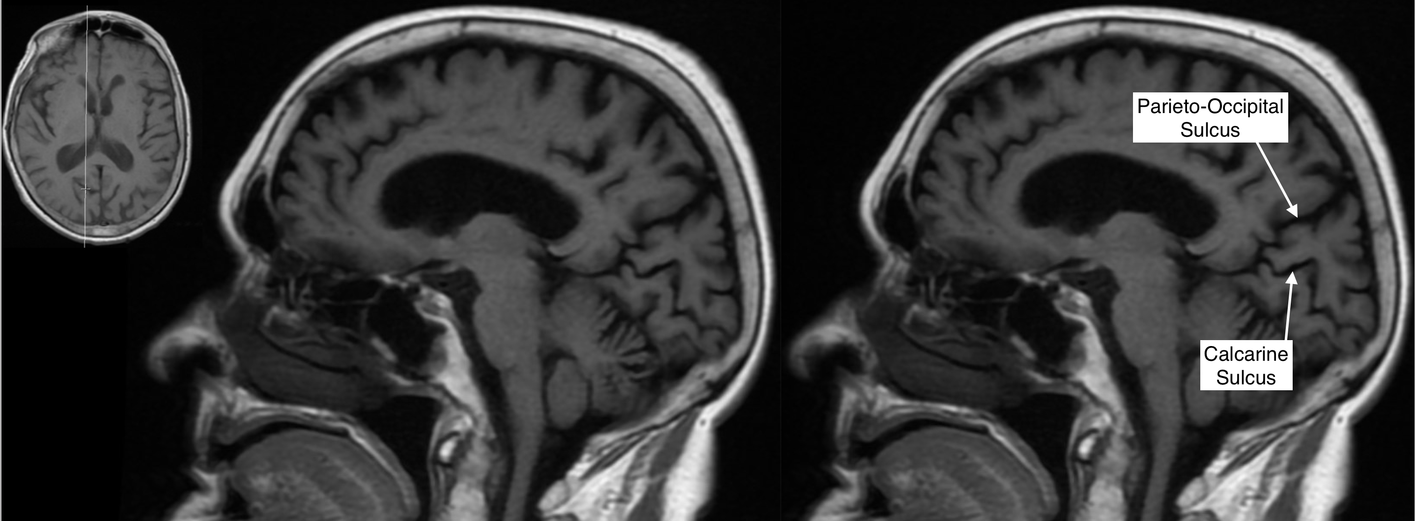 Radiological Anatomy: Parieto-Occipital Sulcus - Stepwards