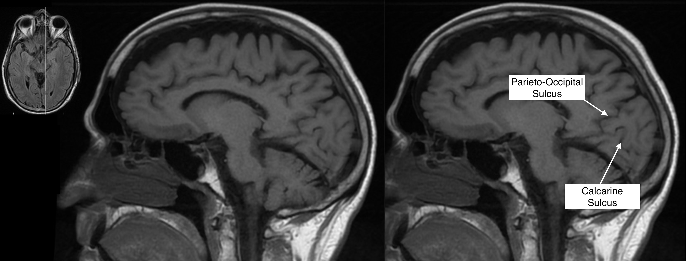 Radiological Anatomy: Calcarine Sulcus - Stepwards