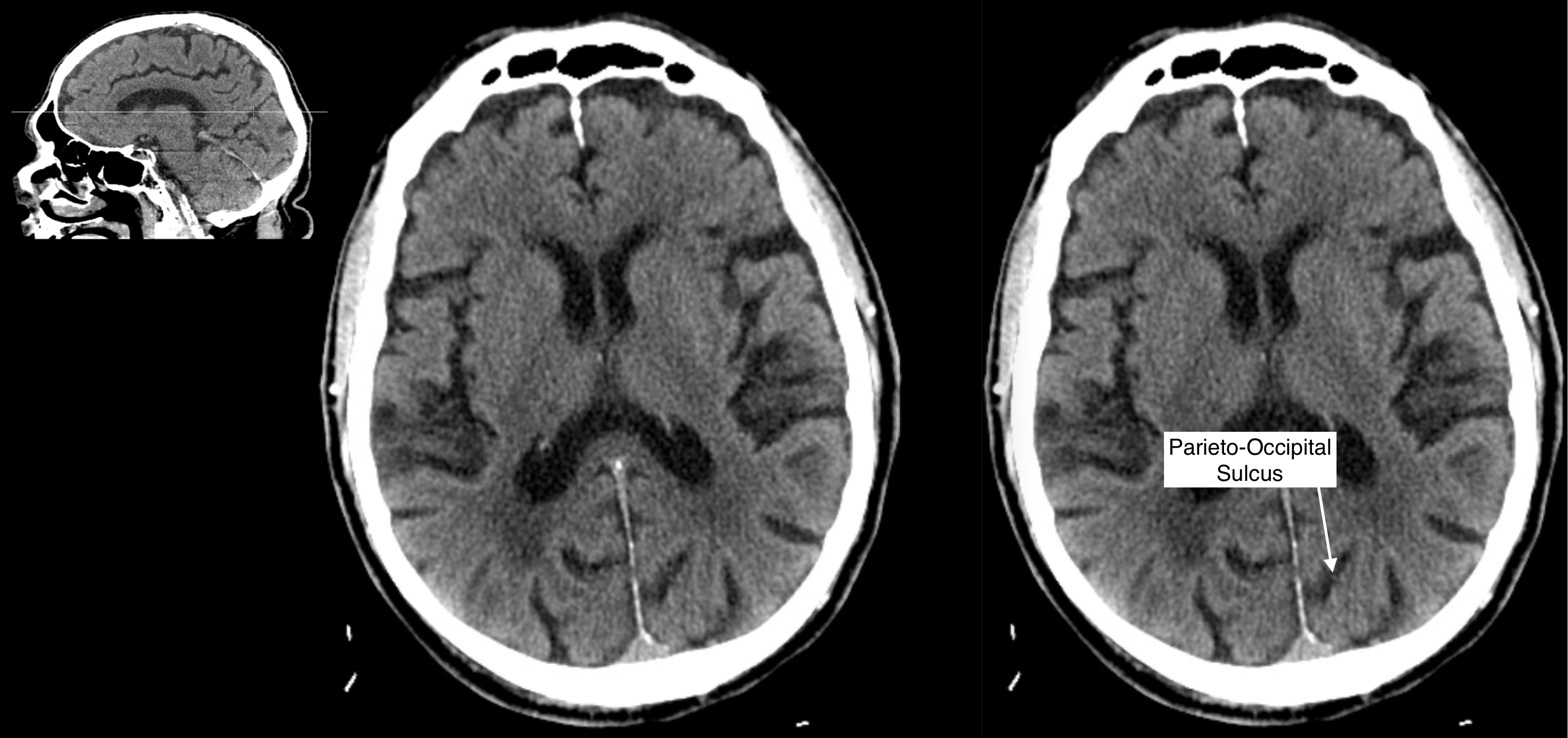 Radiological Anatomy: Parieto-Occipital Sulcus - Stepwards