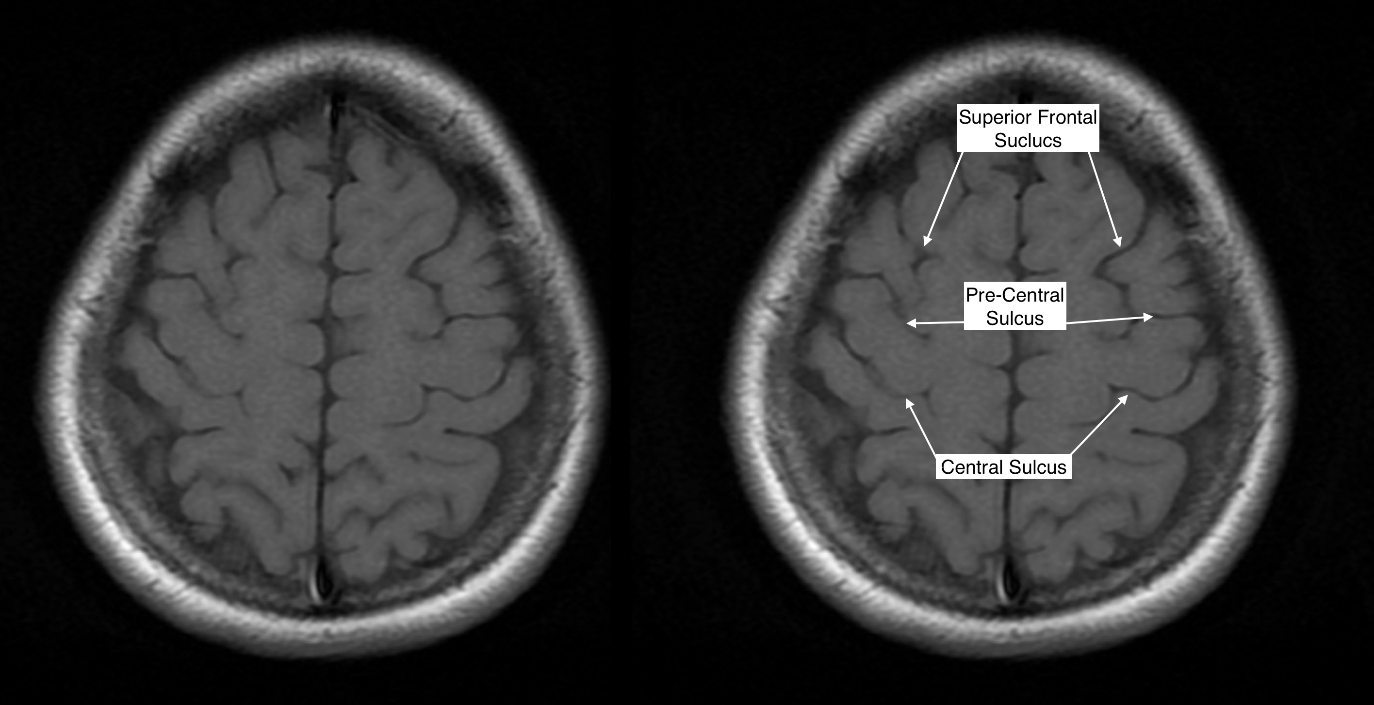 Radiological anatomy central sulcus stepwards