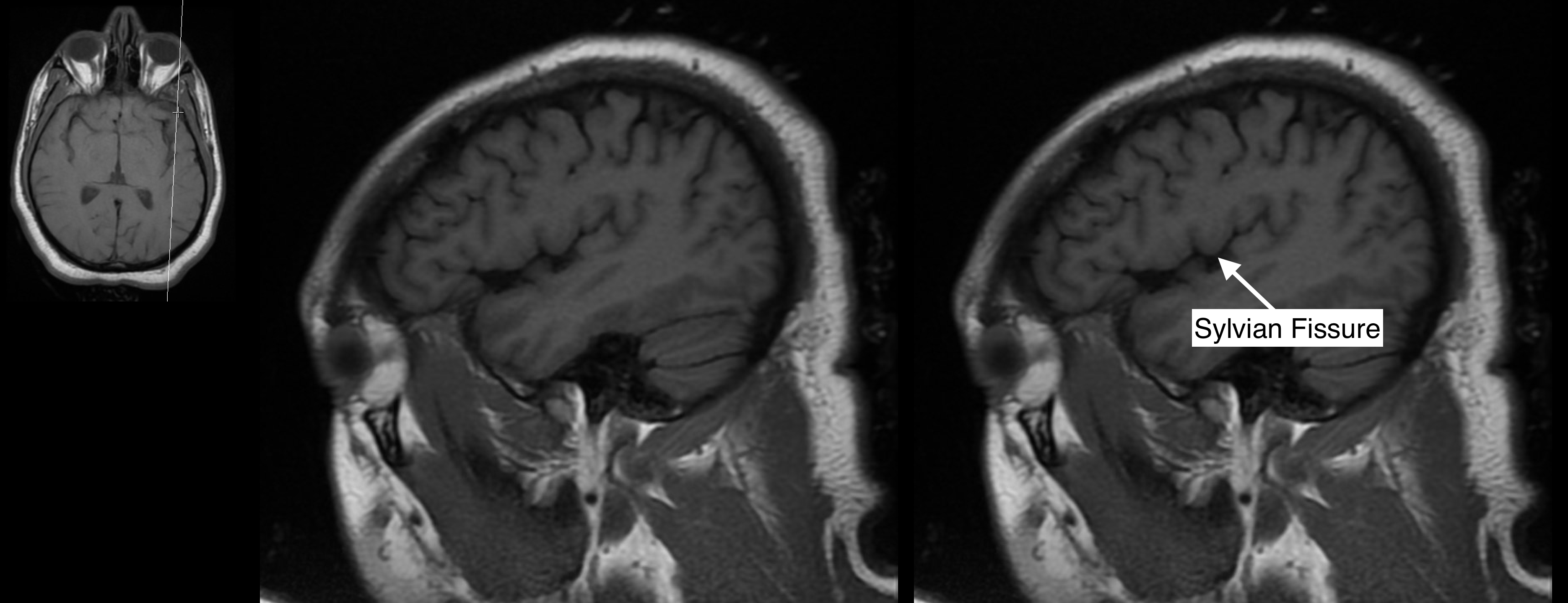 Radiological Anatomy: Sylvian Fissure - Stepwards