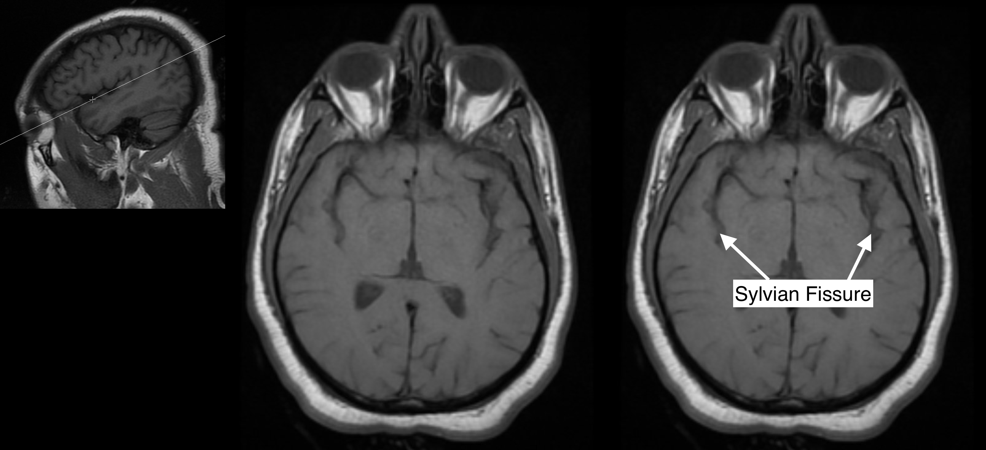 Radiological Anatomy: Sylvian Fissure - Stepwards