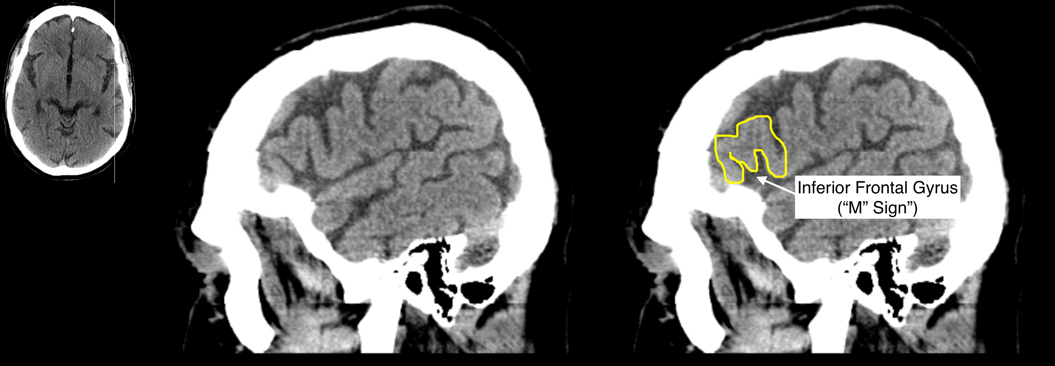 Radiological Anatomy: Inferior Frontal Gyrus - Stepwards