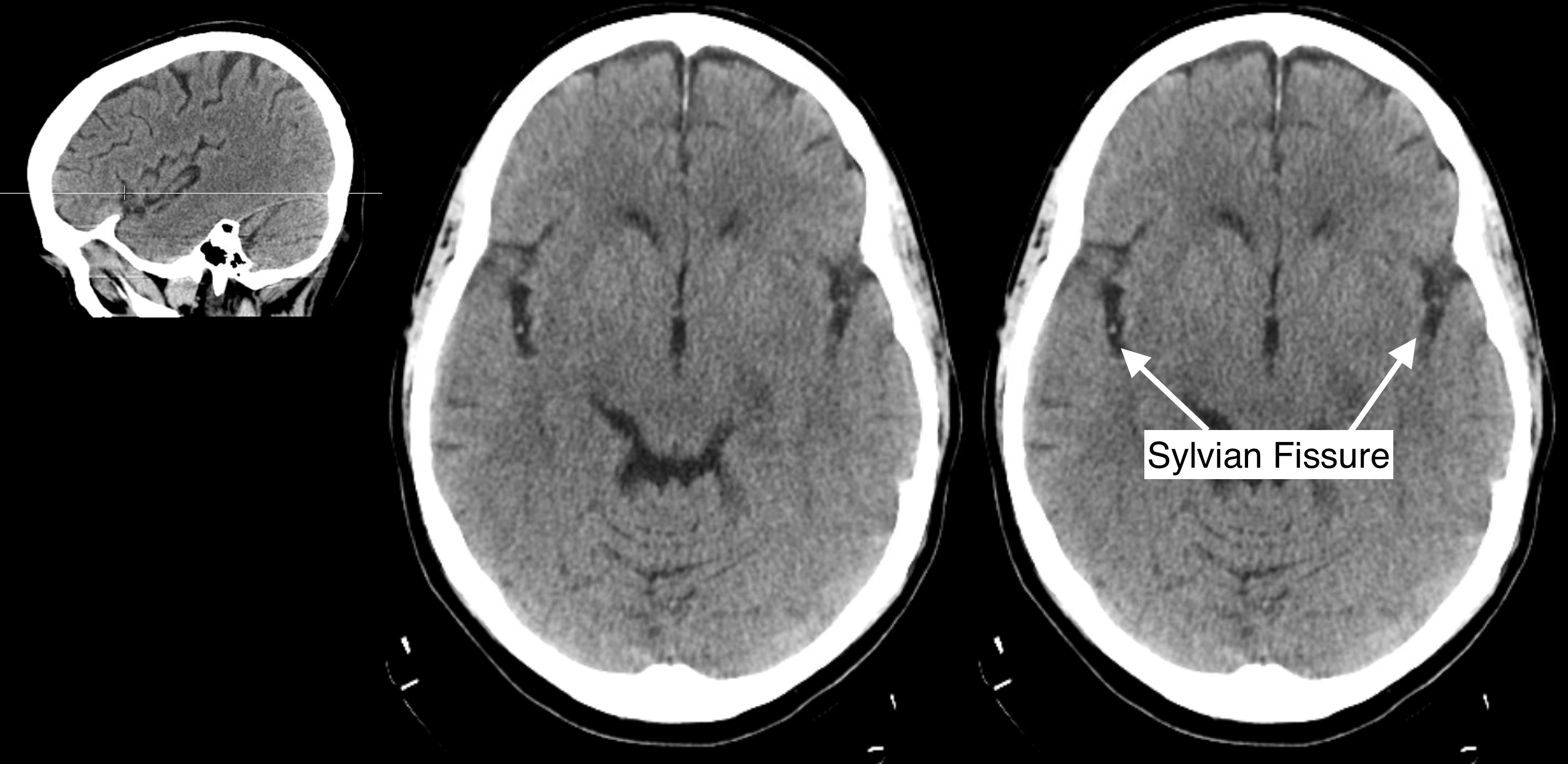 Radiological Anatomy Sylvian Fissure Stepwards what-is-piles-hemorrhoids-difference-between-piles-fissures-and