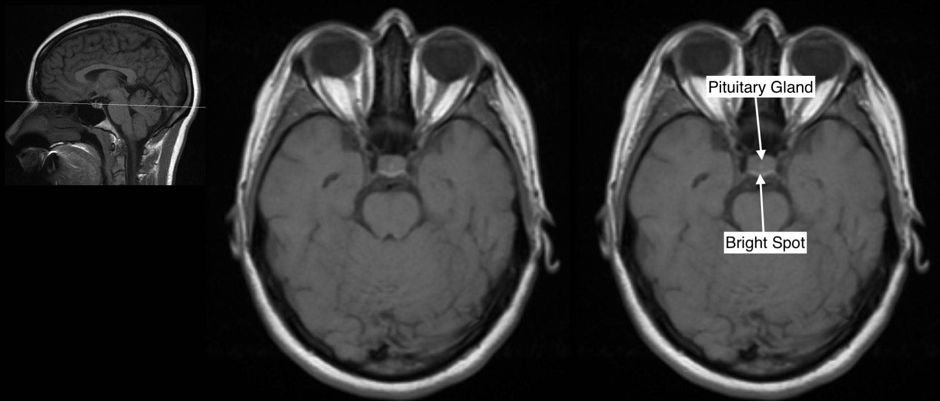 Radiological Anatomy Pituitary Gland Stepwards