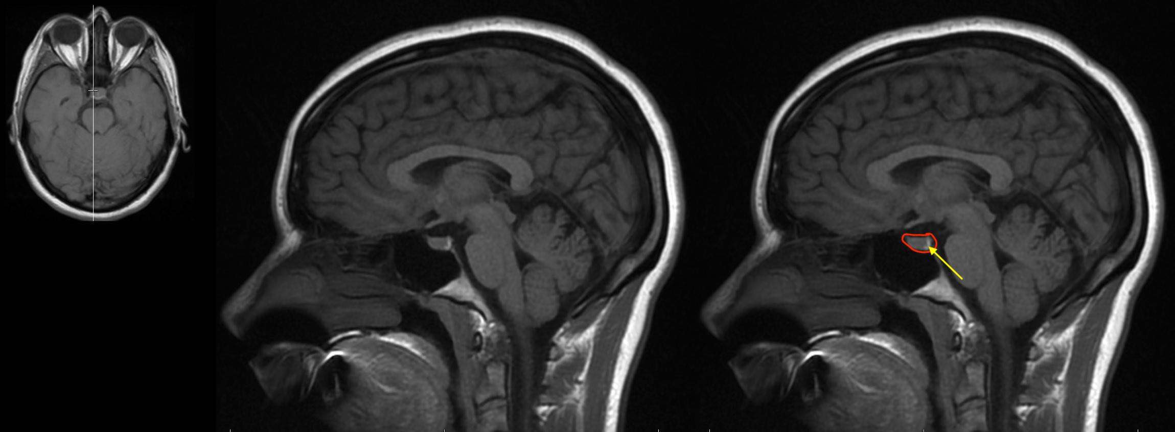 Radiological Anatomy: Pituitary Gland - Stepwards