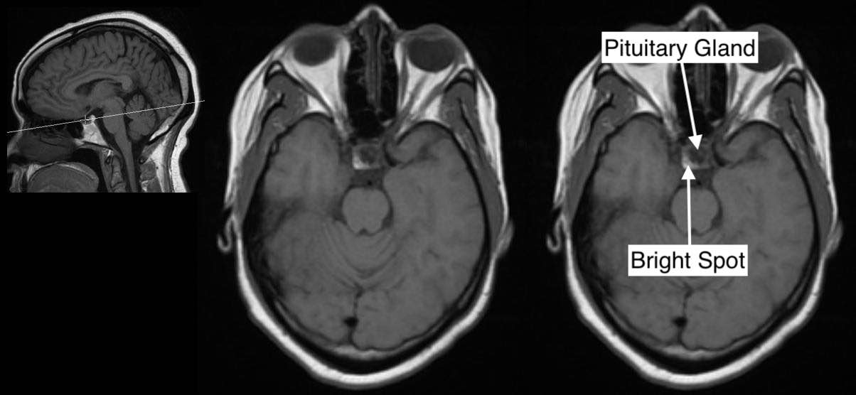 Radiological Anatomy Pituitary Gland Stepwards radiological-anatomy-pituitary-gland-stepwards