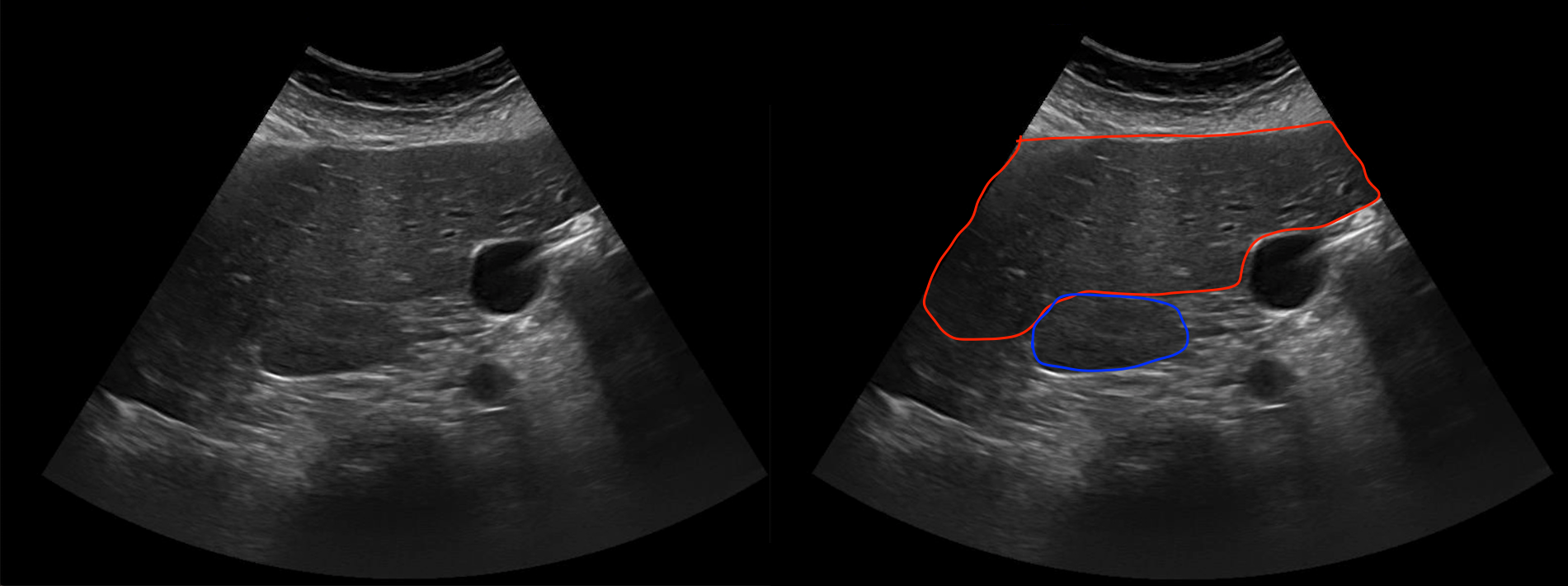 Gallbladder Ultrasound Transverse