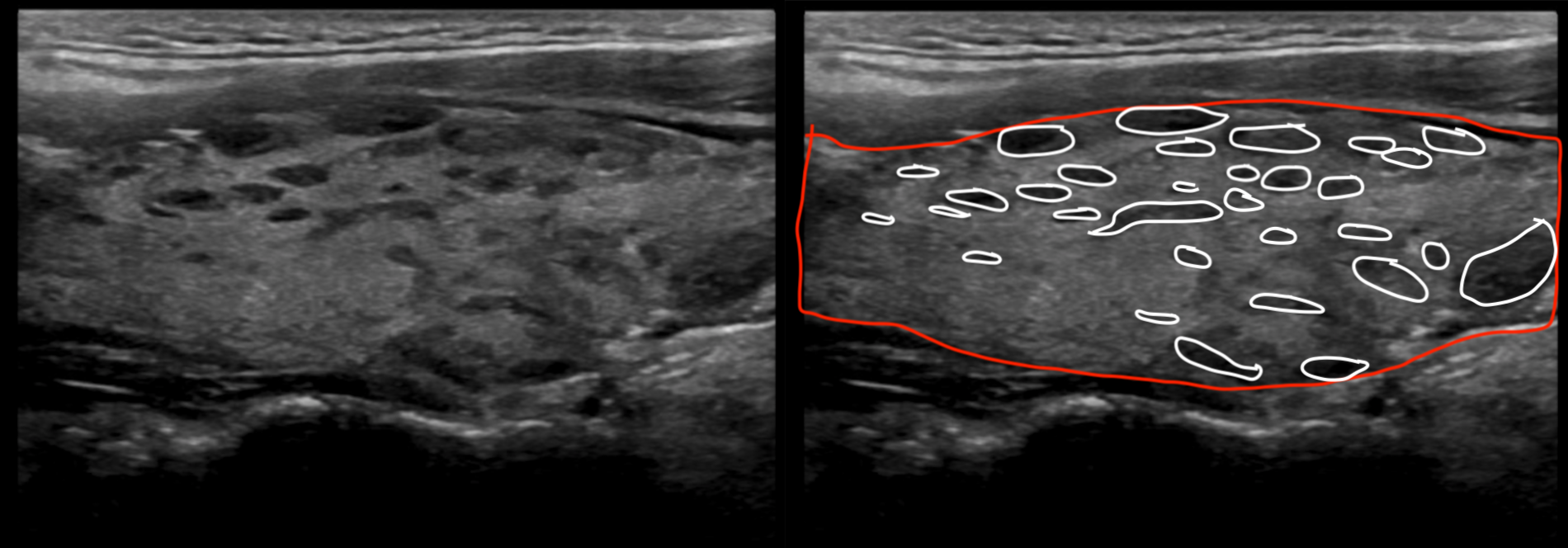 Hashimotos Thyroiditis Ultrasound