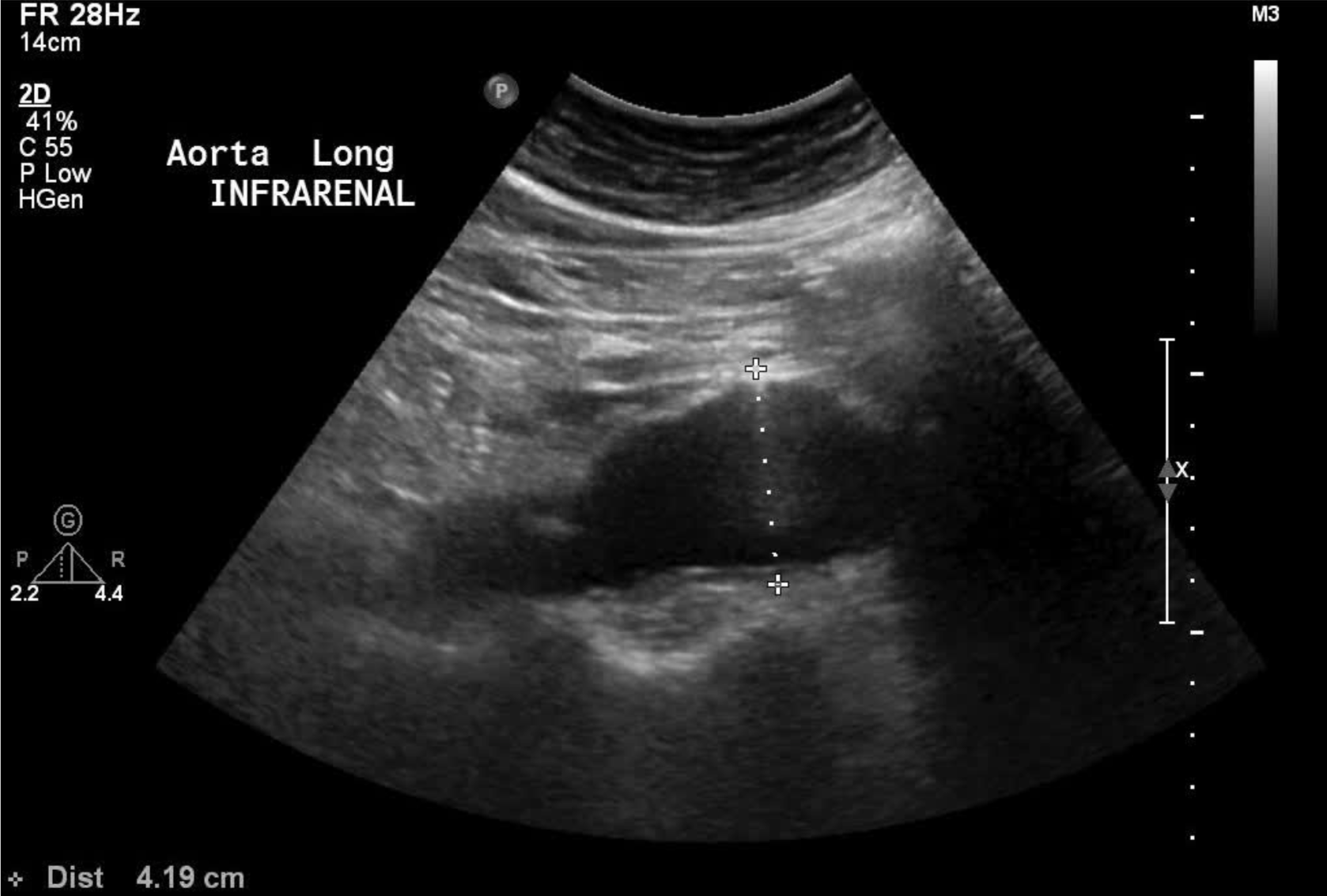 Abdominal Aortic Aneurysm AAA Stepwards
