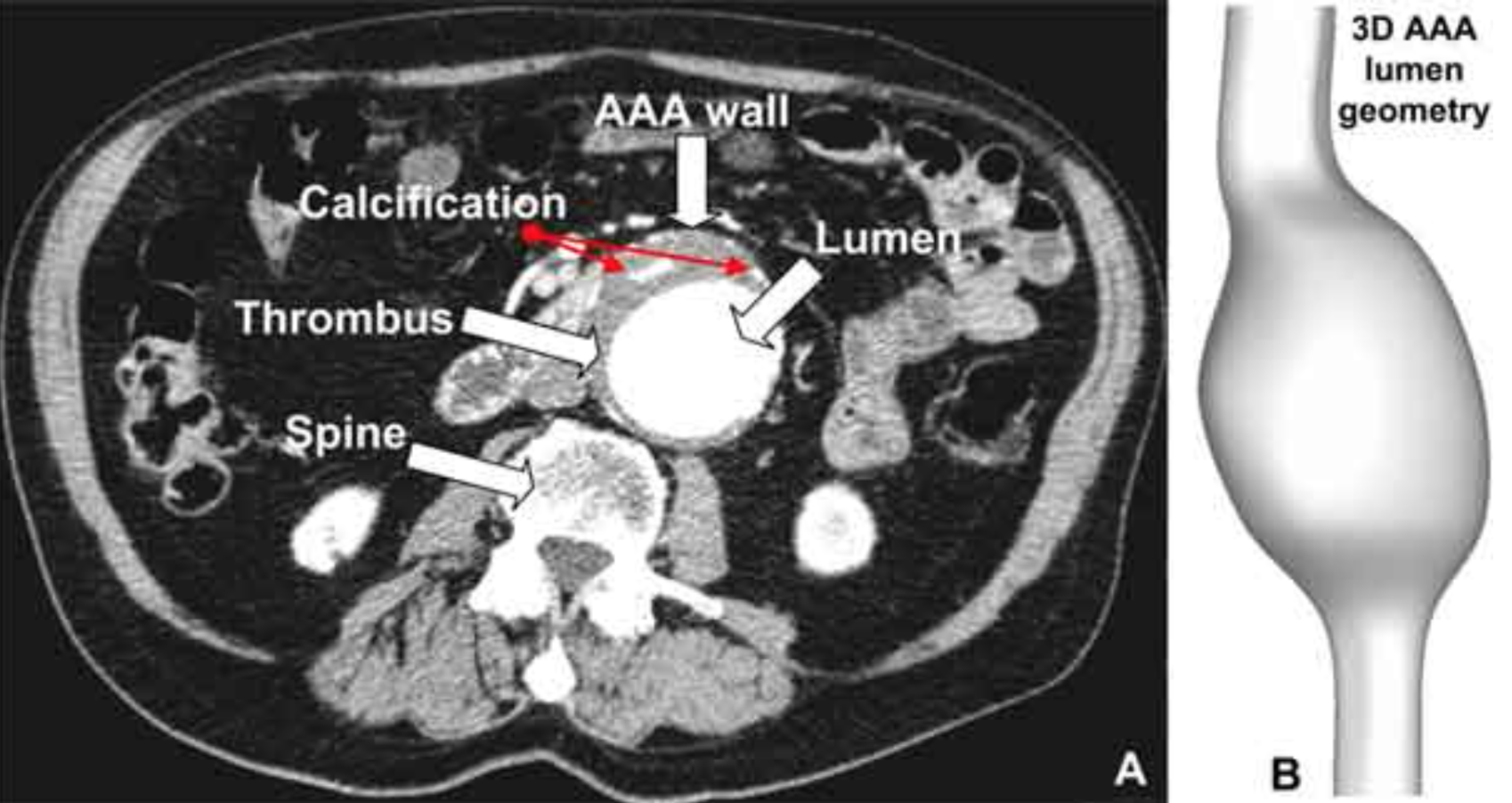 Abdominal Aortic Aneurysm AAA Stepwards