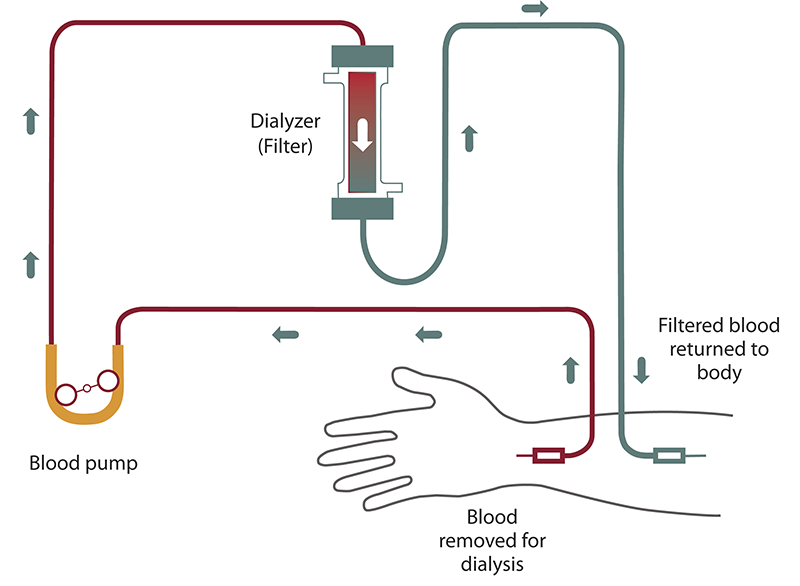 Interventional Radiology Procedures Tunneled Hemodialysis Catheter