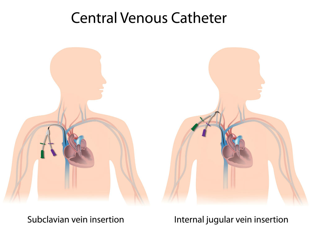Interventional Radiology Procedures Tunneled Hemodialysis Catheter 