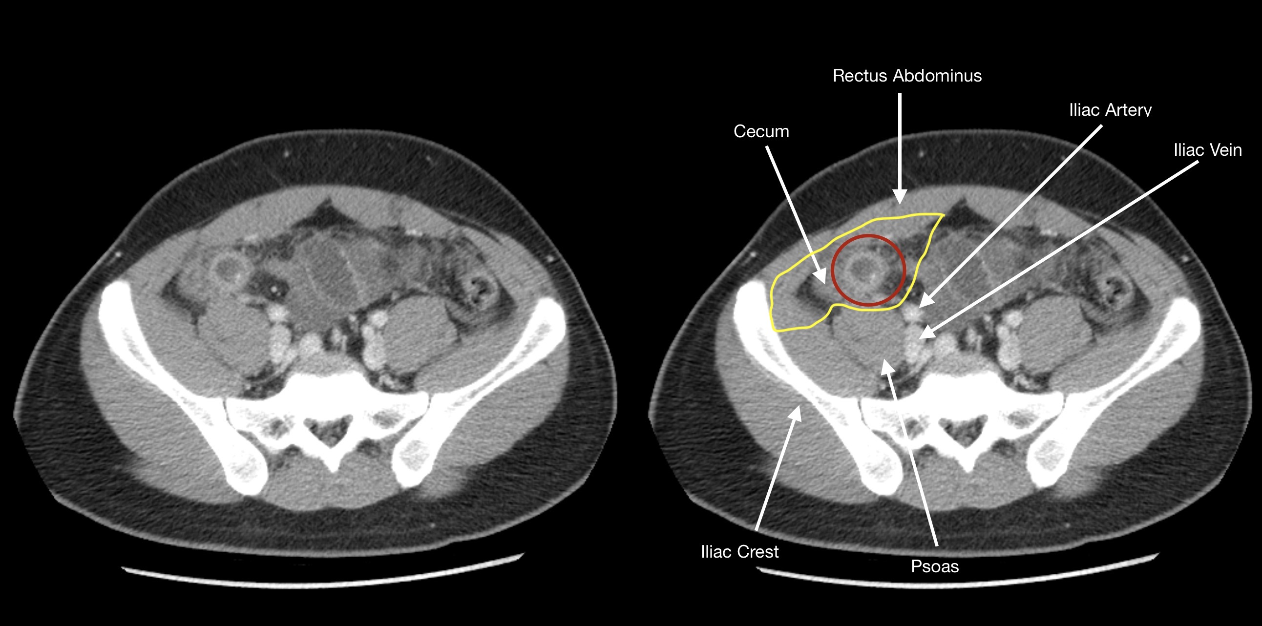 How To Find The Appendix On Imaging Stepwards