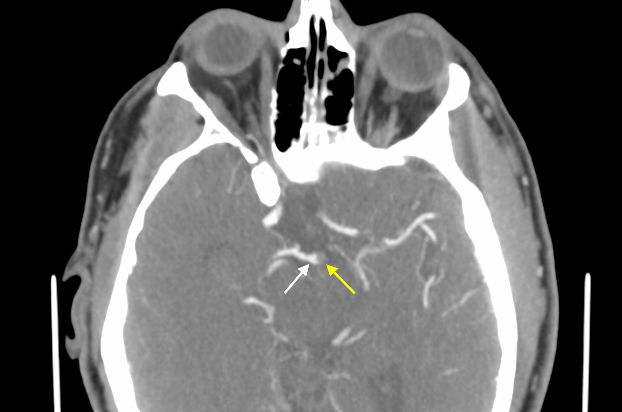 neuroradiology-call-prep-cases-basilar-thrombus-cta-stepwards