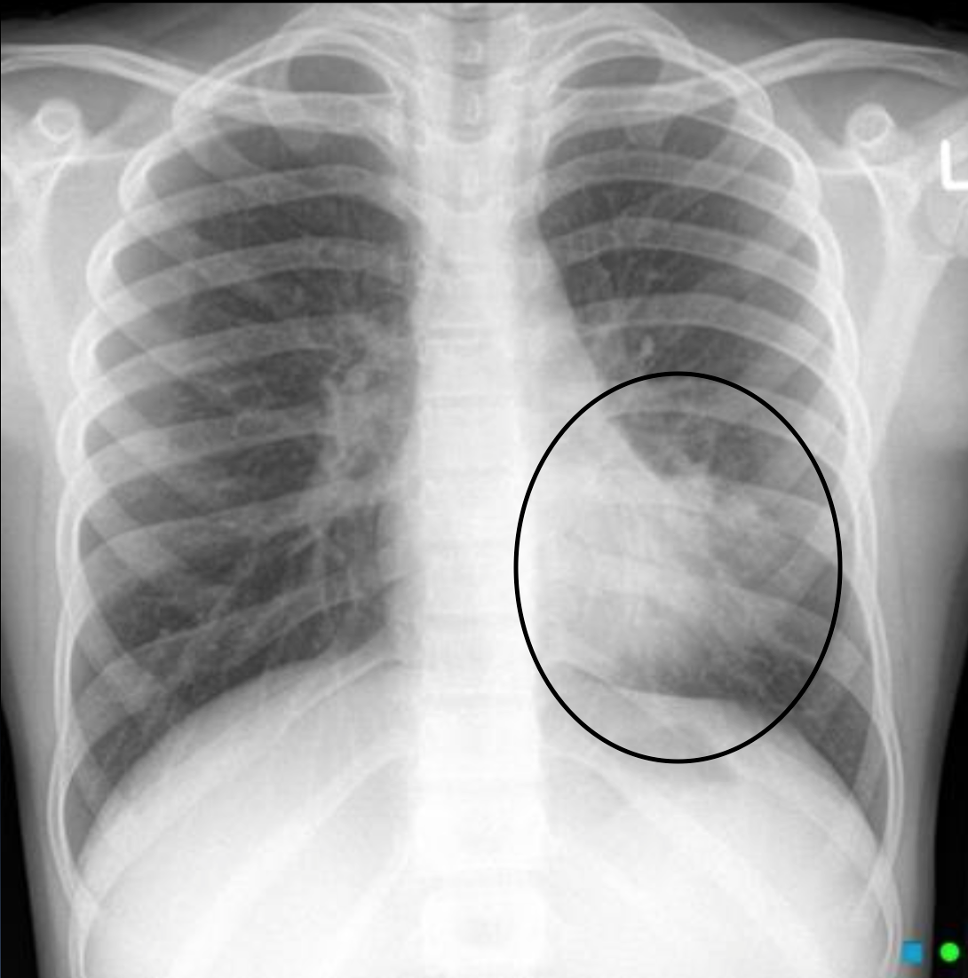 Condition Specific Radiology Pneumonia Stepwards